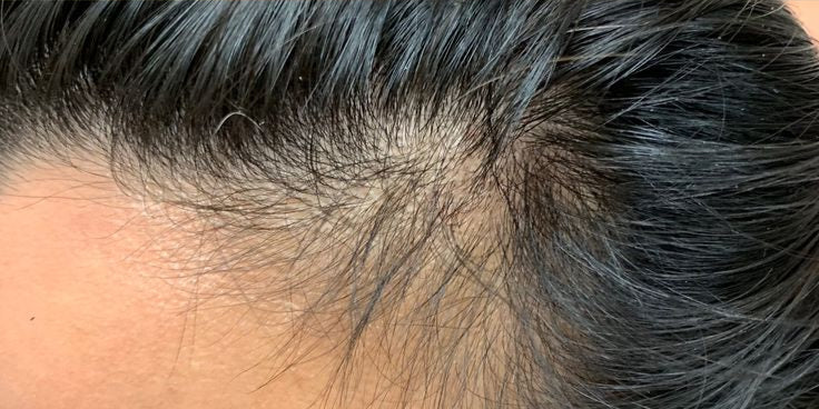 5-in-1 Botanical Hair Growth Serum for Thicker, Fuller, Healthier Hair - Nelymell