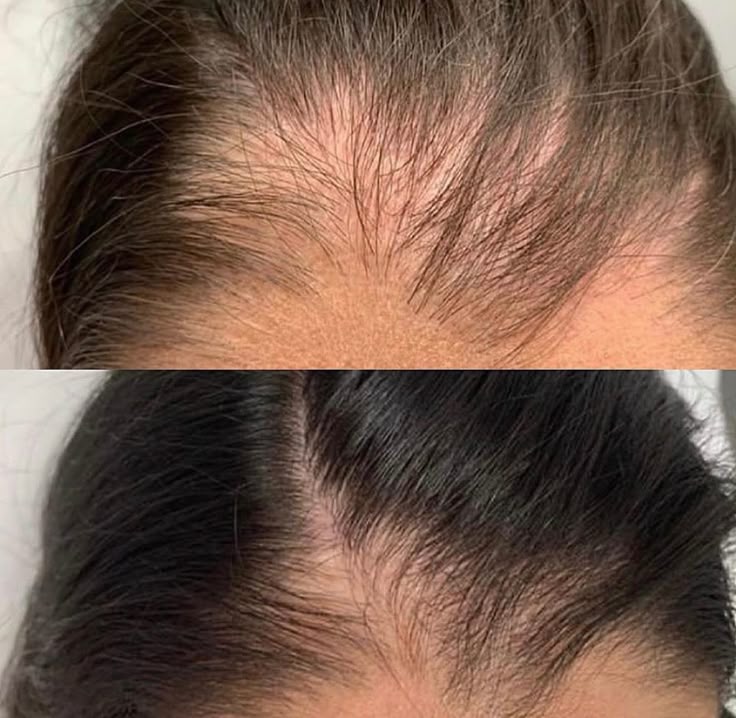 5-in-1 Botanical Hair Growth Serum for Thicker, Fuller, Healthier Hair - Nelymell